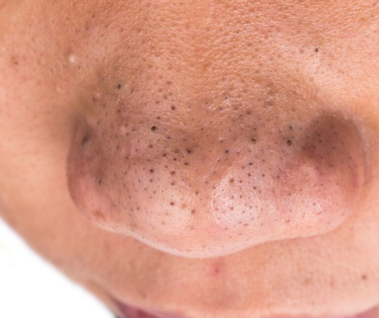 how to get rid of blackheads overnight