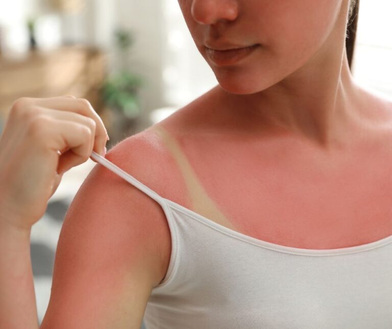 Best Natural Sunburn Relief Tips